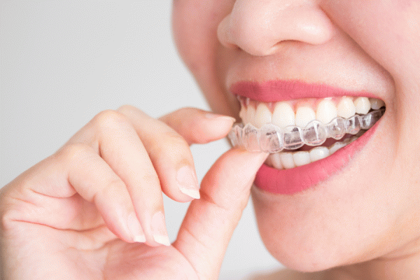 Leczenie nakładkami Invisalign® w Warszawie - ile może kosztować nowy uśmiech?